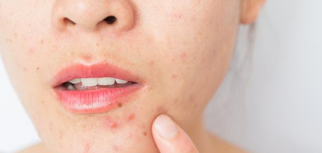 مرجع شامل لكل من استخدمت وتستخدم حبوب Roaccutane لحب الشباب 191