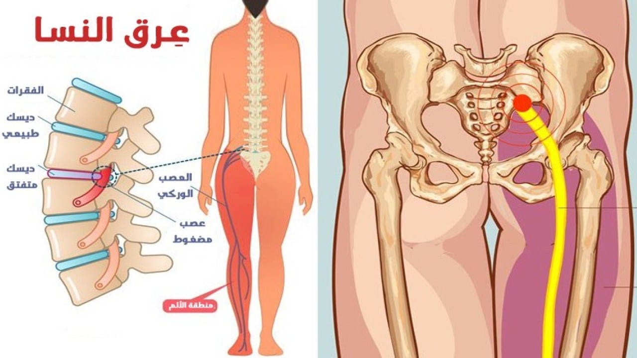 تجاربكم في علاج عرق النسا او الديسك تكفون يابنات تعبانه، علاج عرق النسا 445 1