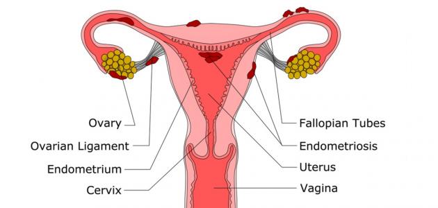 اسوا انواع الاكياس التى توجد في الرحم وهو الكيس الدموى او مرض بطانه الرحم المهاجره او , معلومات طبيه