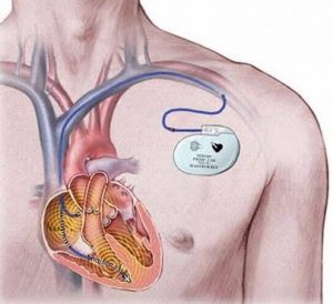 علاج الخفقان عندي باذن الله تجربة شخصية