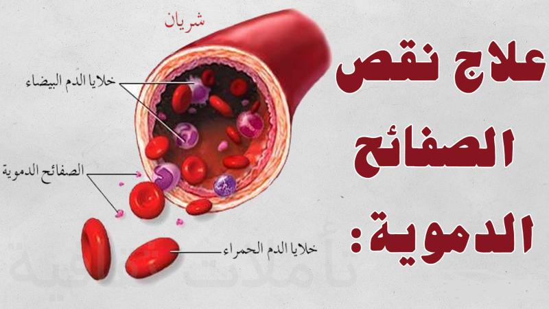 علاج نقص الصفائح الدموية , الحل النهائي الصفائح الدموية