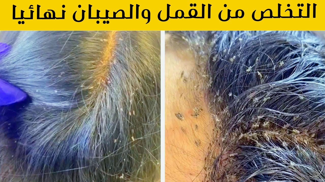 خلطه فتاكه للقمل باذن الله , ازاي تتخلصي من القمل في شعرك ابنتك