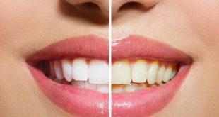 6 طرق منزلية للتخلص من الأسنان الصفراء